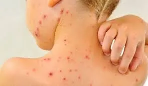 Epidemie de rujeolă în România: 2.000 de cazuri la nivel național