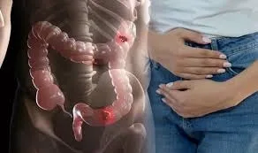 Diagnosticul timpuriu și accesul la tratament, esențiale în cazul cancerului colorectal