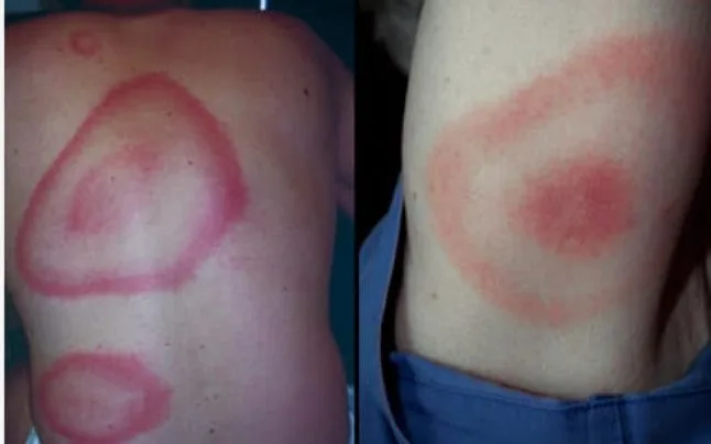 Unul din șapte oameni, afectat de boala Lyme